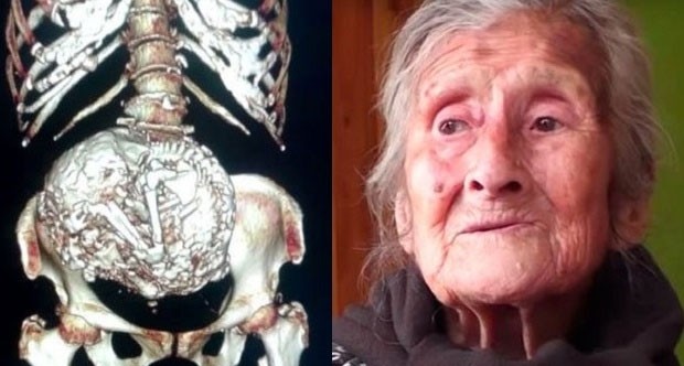 Bebeğini 60 yıl karnında taşıdı!