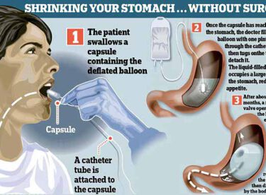 Ameliyatsız, ağrısız mide küçültme…