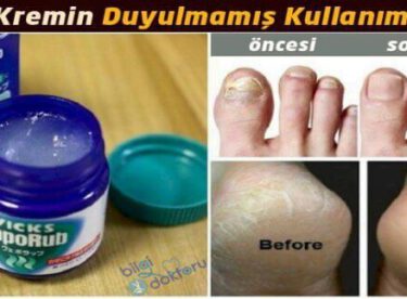 Vicks’in Bilinmeyen Faydaları Ve Kullanım Alanları