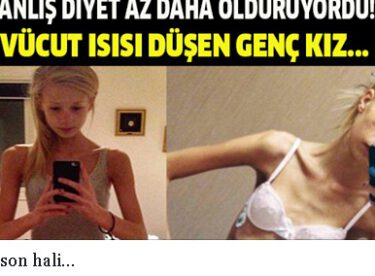 Yanlış diyet az daha öldürüyordu! Vücut ısısı düşen genç kız.. İşte son hali…