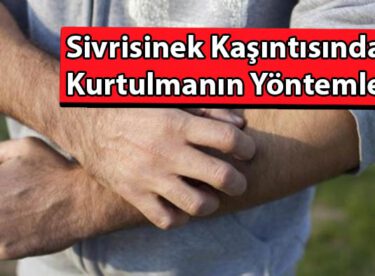 Sivrisinek kaşıntısından kurtulmanın 10 pratik yolu