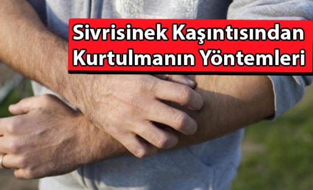 Sivrisinek kaşıntısından kurtulmanın 10 pratik yolu