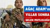 Ağaç Adam Ameliyat Oldu Yepyeni Bir Hayat Şimdi Onu Bekliyor
