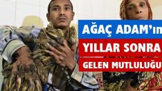 Ağaç Adam Ameliyat Oldu Yepyeni Bir Hayat Şimdi Onu Bekliyor