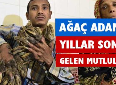 Ağaç Adam Ameliyat Oldu Yepyeni Bir Hayat Şimdi Onu Bekliyor