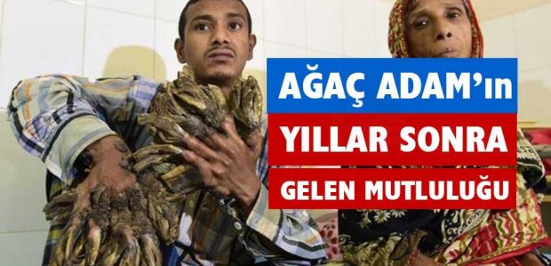 Ağaç Adam Ameliyat Oldu Yepyeni Bir Hayat Şimdi Onu Bekliyor