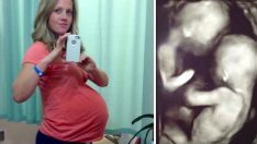 Kadının ikizleri olacaktı Doktorlar Hamile Kadının Karnını Ultrasonla İncelerken Gördüklerine İnanamadılar.