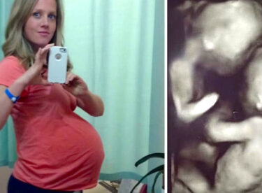Kadının ikizleri olacaktı Doktorlar Hamile Kadının Karnını Ultrasonla İncelerken Gördüklerine İnanamadılar.