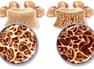 Belli Bir Yaştan Sonra Kadınlarda Kemik Erimesi Bunları Yapmazsanız Kaçınılmaz İşte Korunma Yolları