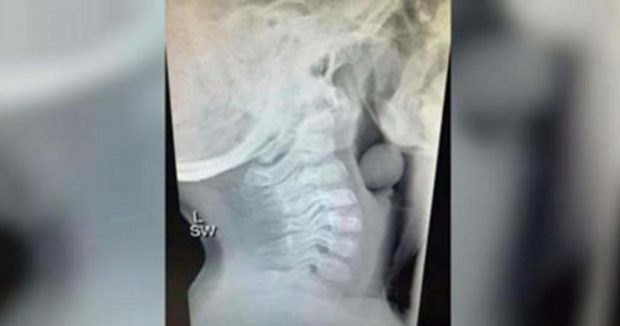 Anne Oğlunun Röntgeninde Gördüklerine İnanamadı – Şimdi Diğer Ebeveynleri Konu Hakkında Uyarıyor