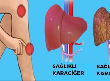 Vücudunuz Önceden Sizi Uyarıyor – İşte Karaciğerinizde Sorun Olduğunu Anlamanın Yolları