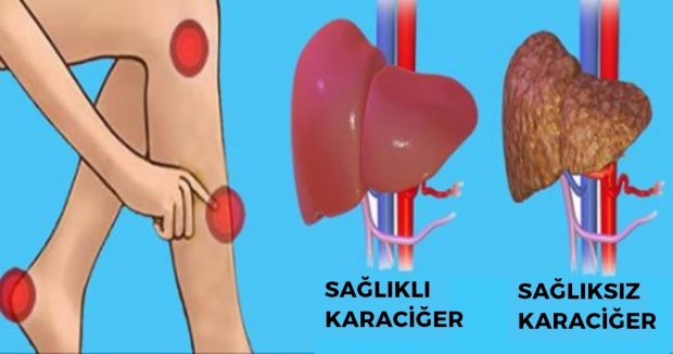 Vücudunuz Önceden Sizi Uyarıyor – İşte Karaciğerinizde Sorun Olduğunu Anlamanın Yolları