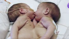 Doktorlar Yapışık İkizlerin Yaşama Şansının Yüzde 5 Olduğunu Söyledi – İkizler Şimdi 2 Yaşında