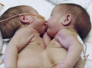 Doktorlar Yapışık İkizlerin Yaşama Şansının Yüzde 5 Olduğunu Söyledi – İkizler Şimdi 2 Yaşında