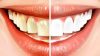 Dişlerinizi Fırçalamadan 15 Dakika Önce Bunu Yaparsanız Dişlerinizin Daha Beyaz Göründüğünün Farkına Varacaksınız