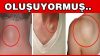 YAĞ BEZELERİ BAKIN NEDEN OLUŞUYORMUŞ.. ÖĞRENİNCE ŞOK OLACAKSINIZ