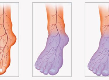 Ellerin ve Ayakların Sürekli Soğuk Olmasının Nedeni Yetersiz Kan Dolaşımıdır İşte Size Doğal Çözüm Yolları