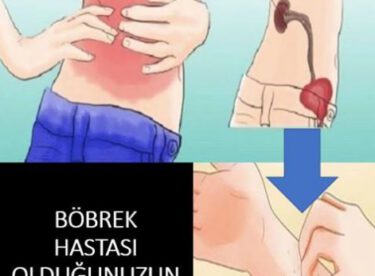 Böbrek Hastalığınız Olduğunun 8 İşareti