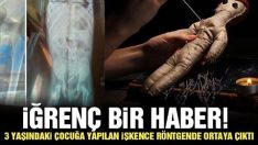 Çocuğa yapılan işkence röntgende ortaya çıktı!