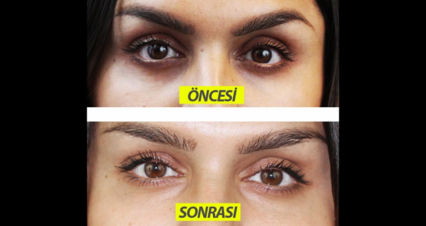 Göz Altı Morluklarından Kurtulmak İçin Öneriler