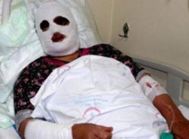 Lavabo açıcıya sıcak su döken kadının yüzü feci şekilde yandı…
