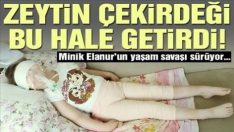 Minik Elanur zeytin çekirdeği yüzünden yatağa mahkum oldu