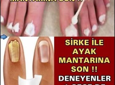 SİRKE İLE AYAK MANTARINA SON !! DENEYENLER 1 GECE DE KURTULUYOR…