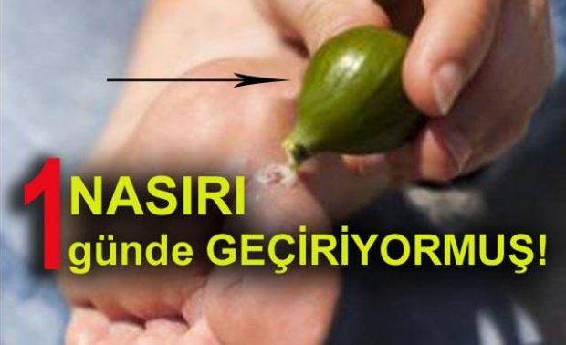 Nasırı 1 günde geçirecek tedavi yöntemleri