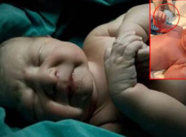 Yeni Doğan Bebek Elinde Annesinin Taktırdığı Spiral İle Dünyaya Geldi
