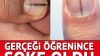 Tırnaktaki bu leke kanserin belirtisi olabilir