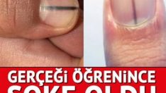 Tırnaktaki bu leke kanserin belirtisi olabilir