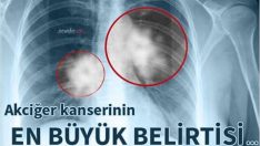 Akciğer kanserinin en büyük belirtileri işte bunlar aman dikkat, erken teşhis edilirse grip kadar basit tedavisi