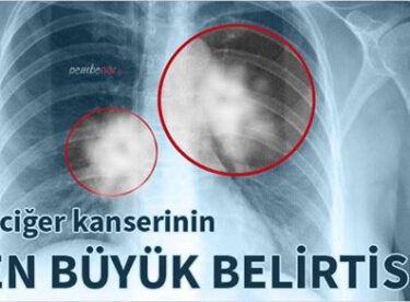 Akciğer kanserinin en büyük belirtileri işte bunlar aman dikkat, erken teşhis edilirse grip kadar basit tedavisi