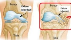 Kireçlenme Sorununa Çözüm Olan Besinler ve Tedavisi İçin Öneriler