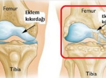 Kireçlenme Sorununa Çözüm Olan Besinler ve Tedavisi İçin Öneriler