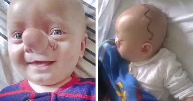 Burnu Yüzünden Çocuğa Pinokyo Deyip Dalga Geçtiler – 3 Yıl Sonra Bakın Nasıl Değişti