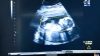 41 Haftalık Hamile Anne Adayı Güvenmediğinden Doktora Hiç Gitmedi – Doktorlar Kadını Muayene Edince Şok Oldular