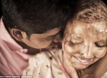 Saplantılı aşığı yüzüne kezzap attı, hayatının aşkını hastanede buldu!