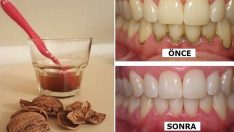 1 Malzemeyle Işık Işıl Dişler! ( Tartar, enfeksiyonlar, iltihaplı diş hastalıkları…)