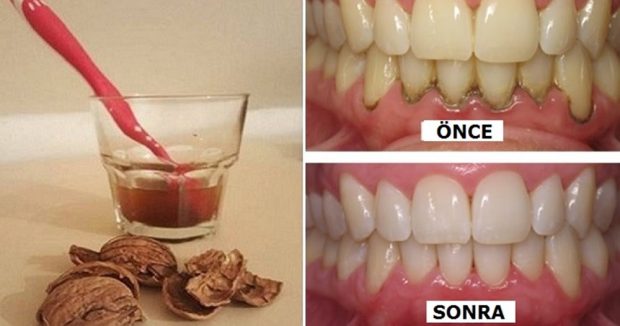 1 Malzemeyle Işık Işıl Dişler! ( Tartar, enfeksiyonlar, iltihaplı diş hastalıkları…)