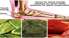 Topuk Dikenine Karşı, Denenmiş 3 Doğal Yöntem