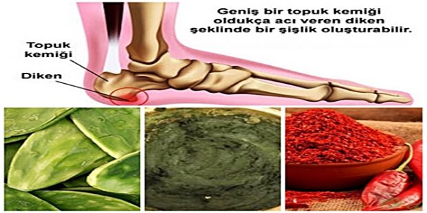 Topuk Dikenine Karşı, Denenmiş 3 Doğal Yöntem
