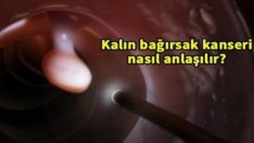 İşte kalın bağırsak kanseri belirtileri ve korunma yolları…
