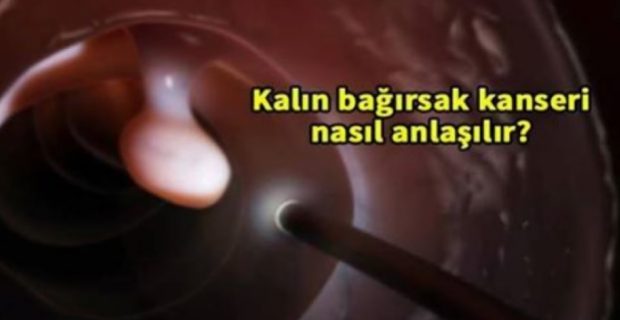 İşte kalın bağırsak kanseri belirtileri ve korunma yolları…
