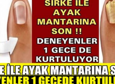 SİRKE İLE AYAK MANTARINA SON !! DENEYENLER 1 GECE DE KURTULUYOR