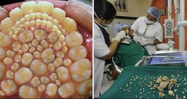 Ağzından tam 232 diş çıktı! Dünya Dişçilik Tarihine Geçti…