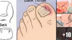 TIRNAK BATMASI TEDAVİSİ ASLINDA BU KADAR BASİTMİŞ