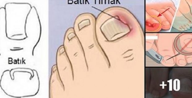 TIRNAK BATMASI TEDAVİSİ ASLINDA BU KADAR BASİTMİŞ