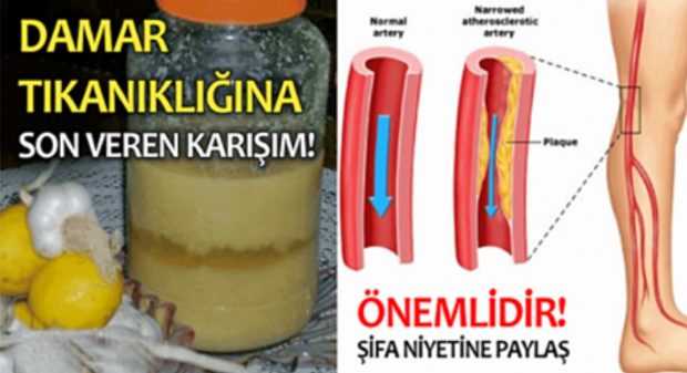 Damar tıkanıklığına iyi gelen doğal karışım..