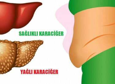 Karaciğerinizin Toksinler ile Dolu Olduğunun 6 İşareti, İşte karaciğerinizin verdiği 6 yardım sinyali!